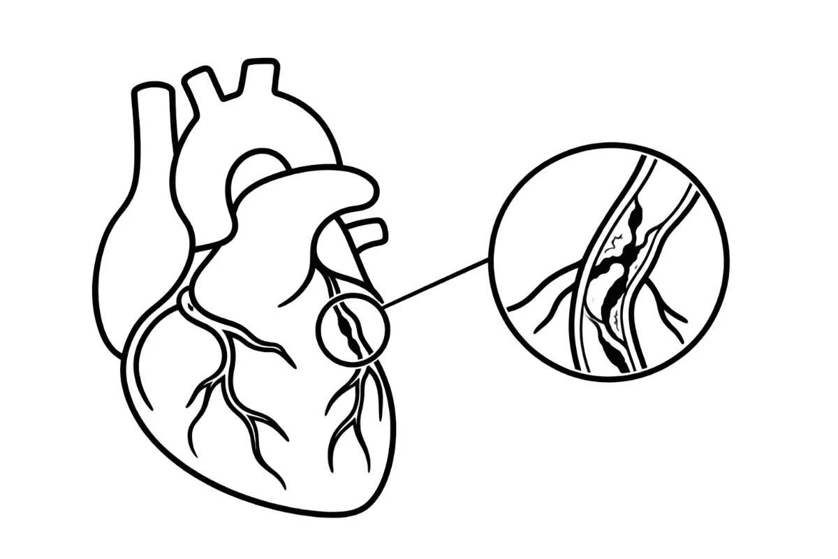 Complex coronary blockages