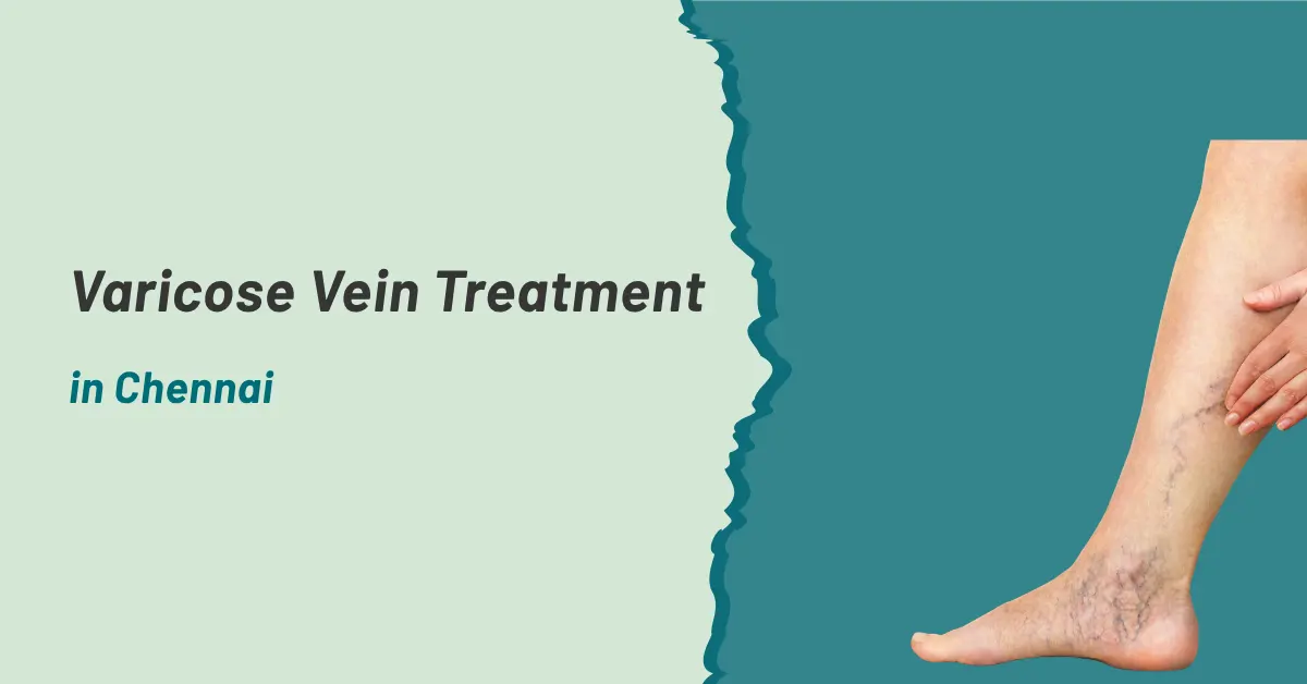 Varicose Vein Treatment in Chennai | Prashanth Hospitals